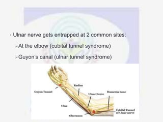 • Ulnar nerve gets entrapped at 2 common sites:
At the elbow (cubital tunnel syndrome)
Guyon’s canal (ulnar tunnel syndrome)
 
