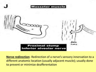 Nerve redirection- Redirection of a nerve’s sensory innervation to a
different anatomic location (usually adjacent muscle); usually done
to prevent or minimize deafferentation
 