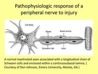 Pathophysiologic response of a
peripheral nerve to injury
A normal myelinated axon associated with a longitudinal chain of
Schwann cells and enclosed within a continuousbasal lamina. (
Courtesy of Don Johnson, Emory University, Atlanta, GA.)
 