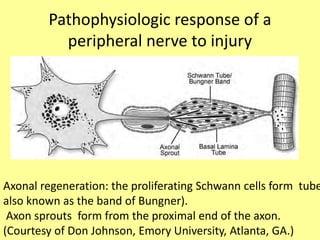 Pathophysiologic response of a
peripheral nerve to injury
Axonal regeneration: the proliferating Schwann cells form tube
also known as the band of Bungner).
Axon sprouts form from the proximal end of the axon.
(Courtesy of Don Johnson, Emory University, Atlanta, GA.)
 
