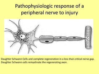 Pathophysiologic response of a
peripheral nerve to injury
Daughter Schwann Cells and complete regeneration in a less than critical nerve gap.
Daughter Schwann cells remyelinate the regenerating axon.
 