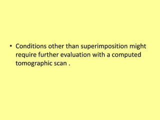 • Conditions other than superimposition might
require further evaluation with a computed
tomographic scan .
 