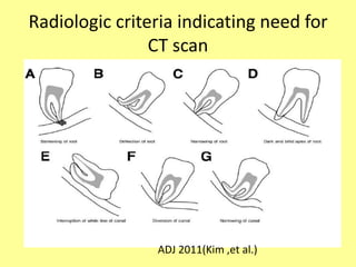 Radiologic criteria indicating need for
CT scan
ADJ 2011(Kim ,et al.)
 