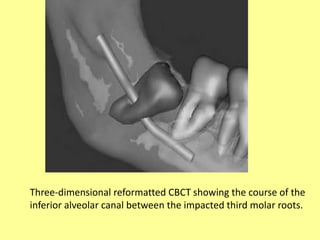 Three-dimensional reformatted CBCT showing the course of the
inferior alveolar canal between the impacted third molar roots.
 