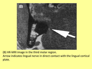 (B) HR-MRI image in the third molar region.
Arrow indicates lingual nerve in direct contact with the lingual cortical
plate.
 