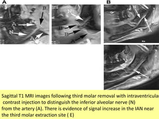 Sagittal T1 MRI images following third molar removal with intraventricular
contrast injection to distinguish the inferior alveolar nerve (N)
from the artery (A). There is evidence of signal increase in the IAN near
the third molar extraction site ( E)
 