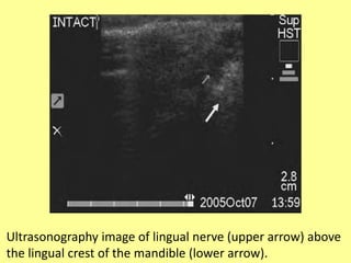 Ultrasonography image of lingual nerve (upper arrow) above
the lingual crest of the mandible (lower arrow).
 
