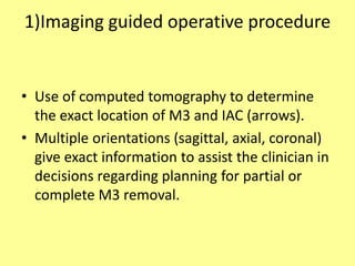 1)Imaging guided operative procedure
• Use of computed tomography to determine
the exact location of M3 and IAC (arrows).
• Multiple orientations (sagittal, axial, coronal)
give exact information to assist the clinician in
decisions regarding planning for partial or
complete M3 removal.
 