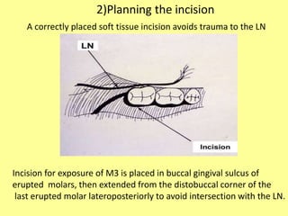 Incision for exposure of M3 is placed in buccal gingival sulcus of
erupted molars, then extended from the distobuccal corner of the
last erupted molar lateroposteriorly to avoid intersection with the LN.
A correctly placed soft tissue incision avoids trauma to the LN
2)Planning the incision
 