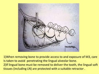 1)When removing bone to provide access to and exposure of M3, care
Is taken to avoid penetrating the lingual alveolar bone.
2)If lingual bone must be removed to deliver the tooth, the lingual soft
tissues (including LN) are protected with a suitable retractor .
 