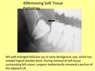 M3 with enlarged follicular sac or early dentigerous cyst, which has
eroded lingual alveolar bone. During removal of soft tissue
surrounding M3 crown, surgeon inadvertently removed a portion of
the adjacent LN .
4)Removing Soft Tissue
Pathology
 