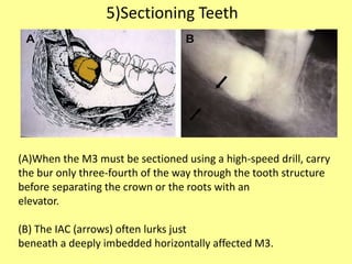 (A)When the M3 must be sectioned using a high-speed drill, carry
the bur only three-fourth of the way through the tooth structure
before separating the crown or the roots with an
elevator.
(B) The IAC (arrows) often lurks just
beneath a deeply imbedded horizontally affected M3.
5)Sectioning Teeth
 
