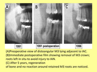 (A)Preoperative view of distoangular M3 lying adjacent to IAC.
(B)Immediate postoperative film showing removal of M3 crown;
roots left in situ to avoid injury to IAN.
(C) After 5 years, regeneration
of bone and no reaction around retained M3 roots are noticed.
 
