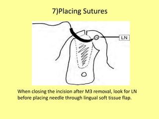 When closing the incision after M3 removal, look for LN
before placing needle through lingual soft tissue flap.
7)Placing Sutures
 