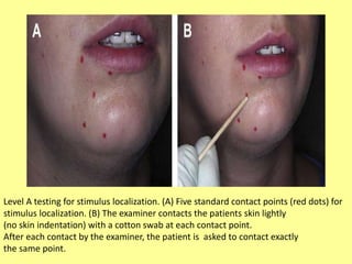 Level A testing for stimulus localization. (A) Five standard contact points (red dots) for
stimulus localization. (B) The examiner contacts the patients skin lightly
(no skin indentation) with a cotton swab at each contact point.
After each contact by the examiner, the patient is asked to contact exactly
the same point.
 
