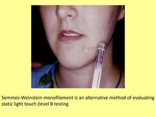Semmes-Weinstein monofilament is an alternative method of evaluating
static light touch (level B testing
 