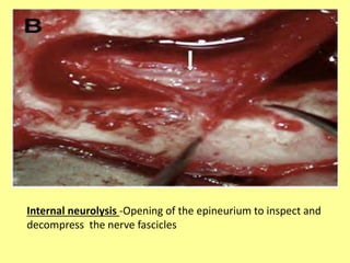 Internal neurolysis -Opening of the epineurium to inspect and
decompress the nerve fascicles
 
