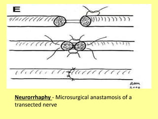 Neurorrhaphy - Microsurgical anastamosis of a
transected nerve
 