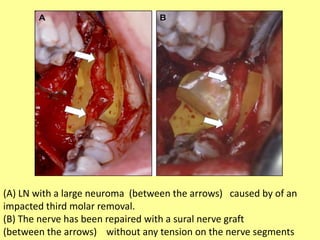 (A) LN with a large neuroma (between the arrows) caused by of an
impacted third molar removal.
(B) The nerve has been repaired with a sural nerve graft
(between the arrows) without any tension on the nerve segments
 