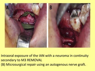 Intraoral exposure of the IAN with a neuroma in continuity
secondary to M3 REMOVAL
(B) Microsurgical repair using an autogenous nerve graft.
 