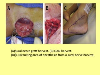 (A)Sural nerve graft harvest. (B) GAN harvest.
(B)(C) Resulting area of anesthesia from a sural nerve harvest.
 