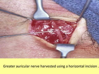Greater auricular nerve harvested using a horizontal incision .
 