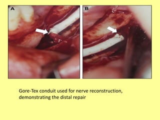 Gore-Tex conduit used for nerve reconstruction,
demonstrating the distal repair
 