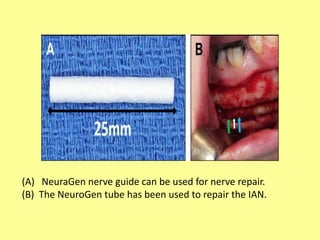(A) NeuraGen nerve guide can be used for nerve repair.
(B) The NeuroGen tube has been used to repair the IAN.
 