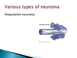 Amputation neuroma:
 