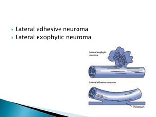  Lateral adhesive neuroma
 Lateral exophytic neuroma
 