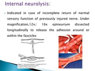  Indicated in case of incomplete return of normal
sensory function of previously injured nerve. Under
magnification,12x/ 16x epineurium dissected
longitudinally to release the adhesion around or
within the fascicles
 