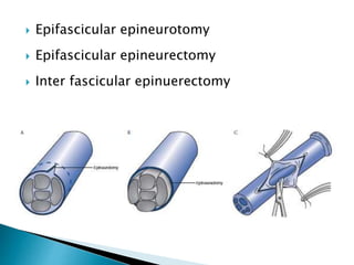  Epifascicular epineurotomy
 Epifascicular epineurectomy
 Inter fascicular epinuerectomy
 