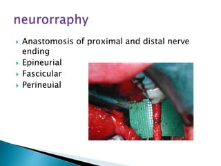  Anastomosis of proximal and distal nerve
ending
 Epineurial
 Fascicular
 Perineuial
 