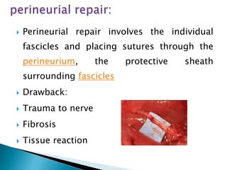  Perineurial repair involves the individual
fascicles and placing sutures through the
perineurium, the protective sheath
surrounding fascicles
 Drawback:
 Trauma to nerve
 Fibrosis
 Tissue reaction
 