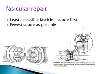  Least accessible fascicle – suture first
 Fewest suture as possible
 
