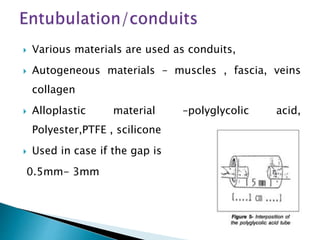  Various materials are used as conduits,
 Autogeneous materials – muscles , fascia, veins
collagen
 Alloplastic material –polyglycolic acid,
Polyester,PTFE , scilicone
 Used in case if the gap is
0.5mm- 3mm
 