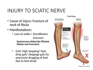 NERVE INJURY-WPS Office. Sciatic nerve and common Peroneal nerve | PPTX