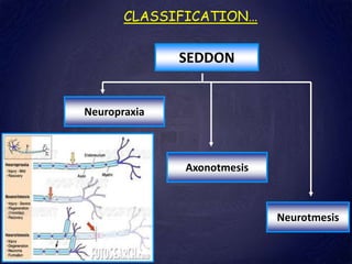 CLASSIFICATION…
SEDDON
Neuropraxia
Axonotmesis
Neurotmesis
 