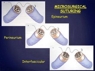 MICROSURGICAL
SUTURING
Interfascicular
Epineurium
Perineurium
 