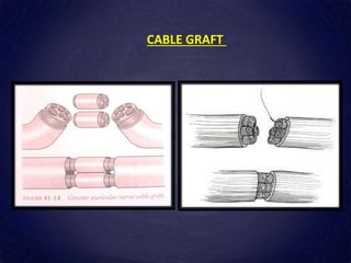 CABLE GRAFT
 