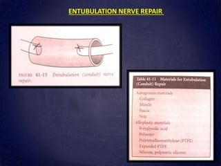 ENTUBULATION NERVE REPAIR
 