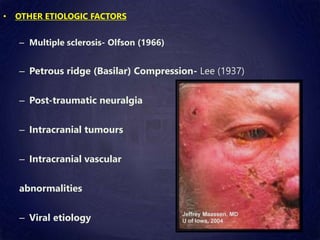 • OTHER ETIOLOGIC FACTORS
– Multiple sclerosis- Olfson (1966)
– Petrous ridge (Basilar) Compression- Lee (1937)
– Post-traumatic neuralgia
– Intracranial tumours
– Intracranial vascular
abnormalities
– Viral etiology
 