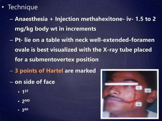 • Technique
– Anaesthesia + Injection methahexitone- iv- 1.5 to 2
mg/kg body wt in increments
– Pt- lie on a table with neck well-extended-foramen
ovale is best visualized with the X-ray tube placed
for a submentovertex position
– 3 points of Hartel are marked
– on side of face
• 1ST
• 2ND
• 3RD
 