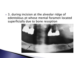  3. during incision at the alveolar ridge of
edentolous pt whose mental foramen located
superficially due to bone resoption
 