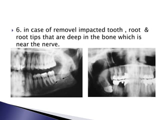  6. in case of removel impacted tooth , root &
root tips that are deep in the bone which is
near the nerve.
 