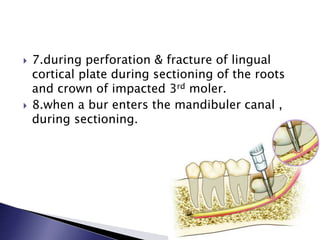  7.during perforation & fracture of lingual
cortical plate during sectioning of the roots
and crown of impacted 3rd moler.
 8.when a bur enters the mandibuler canal ,
during sectioning.
 