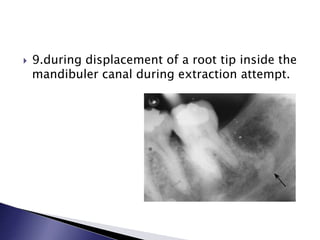  9.during displacement of a root tip inside the
mandibuler canal during extraction attempt.
 