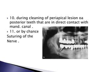  10. during cleaning of periapical lesion oa
posterior teeth that are in direct contact with
mand. canal .
 11. or by chance
Suturing of the
Nerve .
 