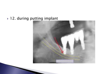  12. during putting implant
 