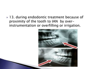  13. during endodontic treatment because of
proximity of the tooth to IAN by over-
instrumentation or overfilling or irrigation.
 